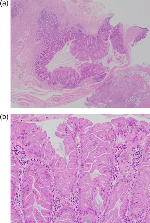 (a and b) Histopathological examination of sections of the polyp showing long fronds of the adenoma lined by dysplastic epithelial cells characterized by nuclear pleomorphism and elongated finger-like villous projections.