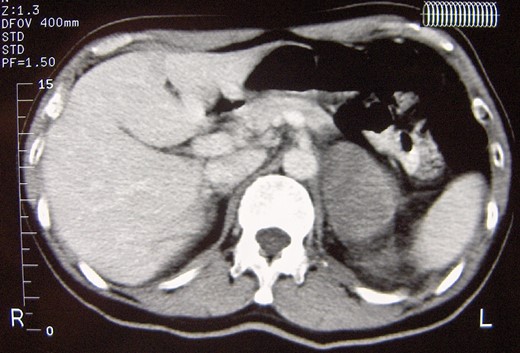 Abdominal computed tomography showing a well circumscribed 8 cm mass of the left adrenal gland with no signs of local spread or lymph node involvement.