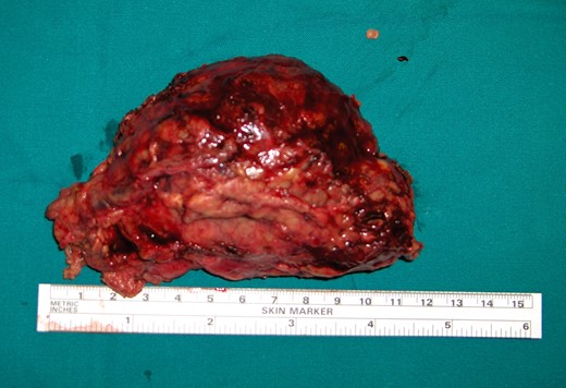 Macroscopic appearance of the left adrenal tumor.