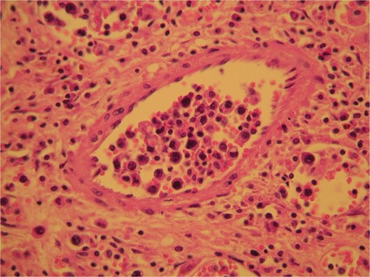 H&E sections revealed the presence of tumor cells inside dilated, thin-walled vascular spaces exhibiting minimal cytoplasm and irregular nuclei with atypia.