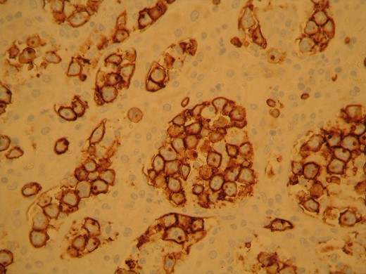 The neoplastic cells stained positive for CD20 confirming the presence of B lymphocytes.