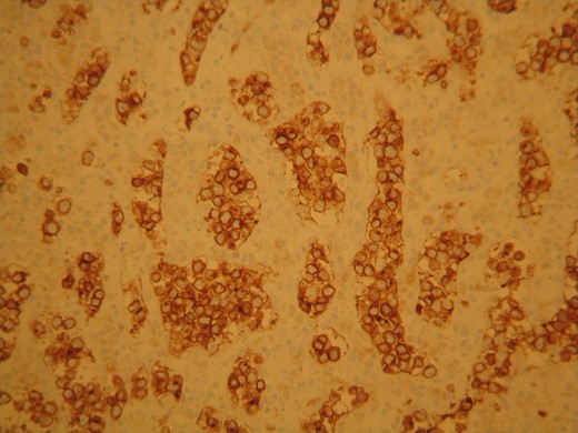 The neoplastic cells stained positive for CD79 characteristic for B lymphocytes presence.