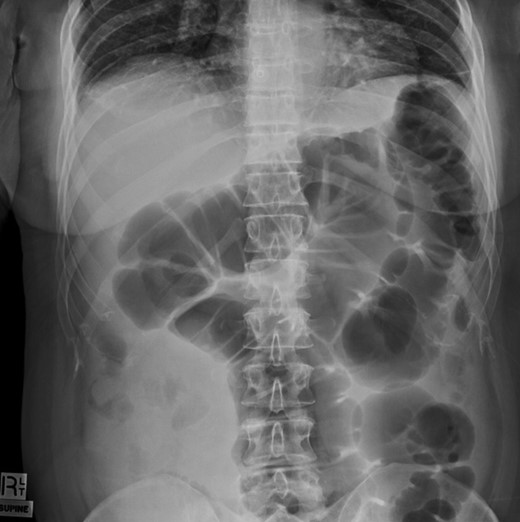 Plain film of abdomen showing colonic gaseous distension following colonoscopy.