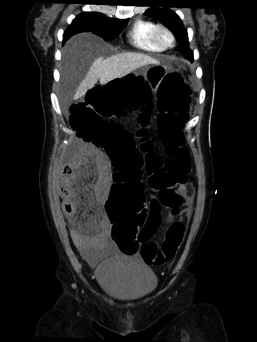 CT coronal view showing pericaecal internal hernia of ileal loops demonstrating features of ischemia.