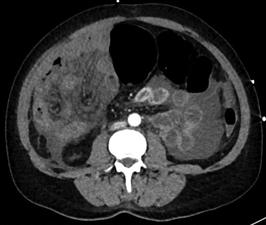 CT axial view showing dilated colon, internal hernia with ischemic small bowel loops, free fluid, but no free gas.