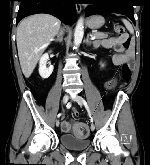Abdominal CT scan ileo-ileal intussusception with a target sign (arrow).