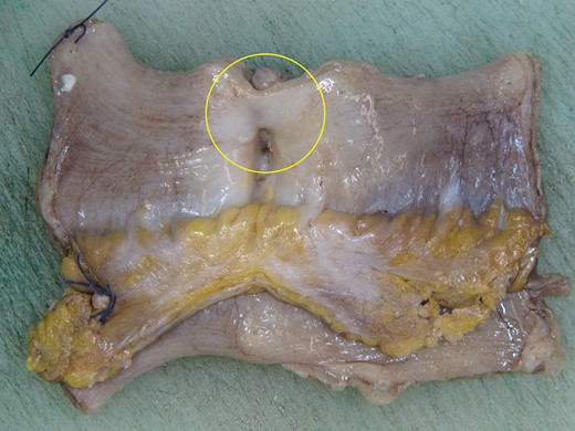 Gross photograph of resection specimen showing the ileal leiomyosarcoma (yellow circle).