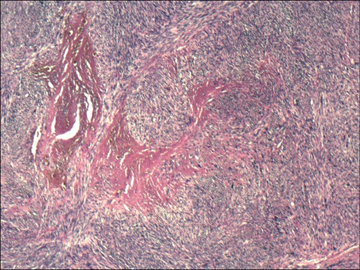 Haematoxylin and eosin stained section showing a spindle-celled tumour with pleomorphic nuclei and pronounced mitotic activity.