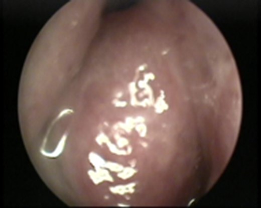 Nasal endoscopy image showing a soft tissue mass arising from the right lateral nasal wall.