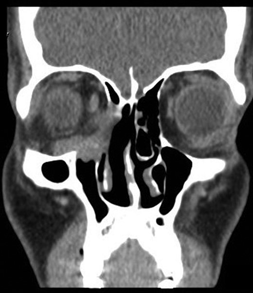 Contrast enhanced computed tomography scan. Coronal CT scan with contrast of PNS showing an enhancing soft tissue lesion in the right ethmoid, eroding the medial and inferior orbital walls.