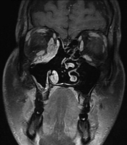Magnetic resonance imaging (MRI) showing an enhancing soft tissue mass in the ethmoid sinus, eroding inferio-medial orbital wall.