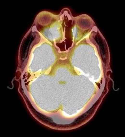 Positron emission tomography scan. PET scan showing an ill-defined 4.5 × 4.2 cm2 mass lesion in the right nasal cavity, maxillary and ethmoid sinuses extending to the right medial orbital floor.