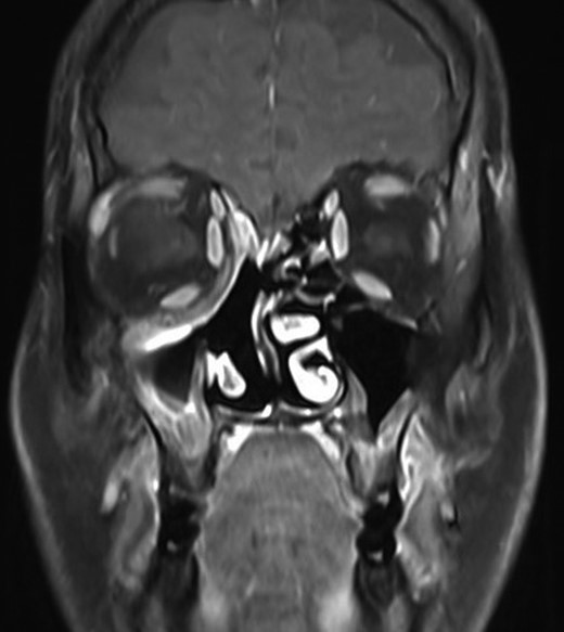Magnetic resonance imaging after treatment. MRI post treatment showing total resolution of the tumor.