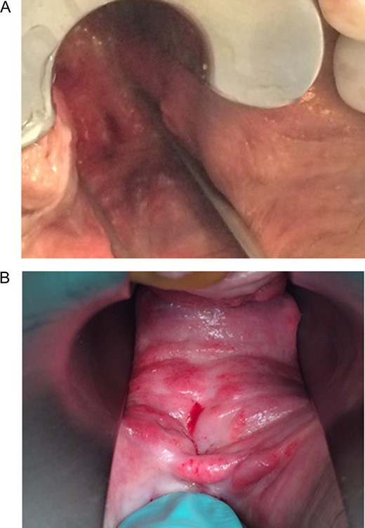 (A and B) A rectovaginal fistula orifice located 5 cm from the anal border. (A)View from the rectum. (B) View from the vagina.