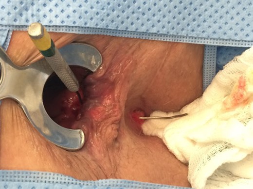Image showing the compartment communication via the fistula tract.