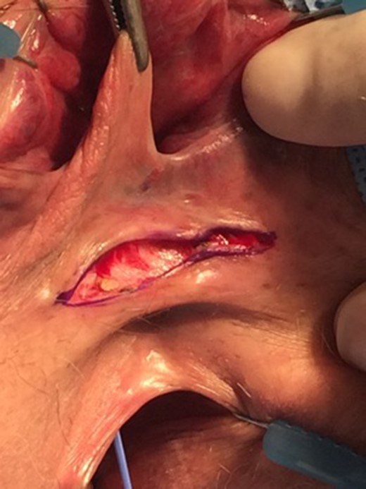 Transverse perineal incision through rectovaginal septum.