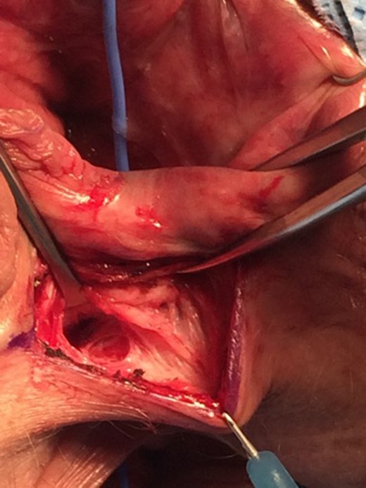 Separation of the vagina from sphincter and anal wall.