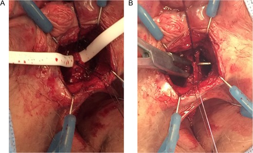 (A and B) Marking of the fistula tract. (A) Penrose drainage used to identify fistula tract. (B) Lift procedure view.