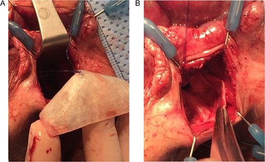 (A and B) Placement of the Biomesh at the rectovaginal septum with sutures and fibrin sealant.