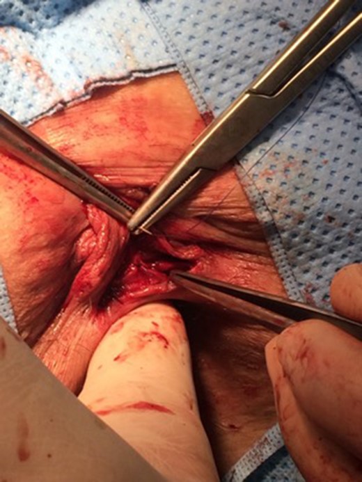 Closure of perineal surgical wound by sutures.