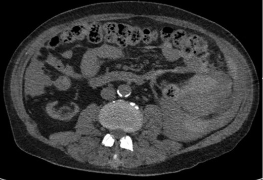Axial CT imaging showing hemoperitoneum secondary to splenic rupture.