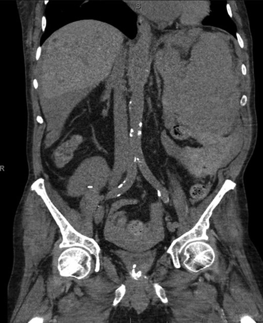 Coronal CT imaging demonstrating splenomegaly with splenic capsule rupture at the inferior pole with heterogeneous fluid in the paracolic gutters and perisplenic region suggestive of hemoperitoneum.
