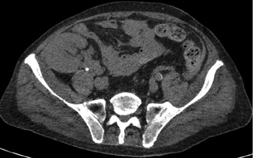 Axial CT imaging of the pelvis demonstrating heterogeneous fluid (blood) in the pelvic small bowel mesentery. Also shown is the patient’s renal transplant with clear perinephric fat planes. The renal graft was grossly uninvolved and viable appearing at the time of laparotomy.