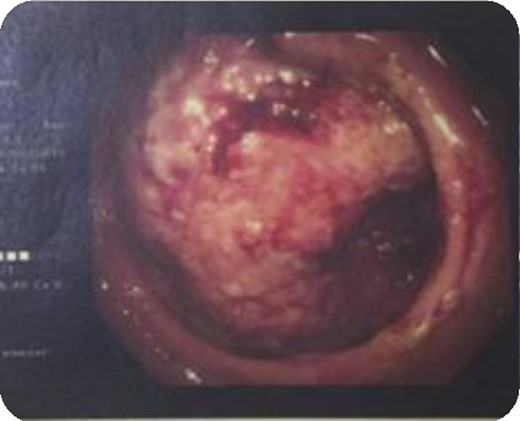 Rectal cancer annular obstructing 5 cm from anal verge.