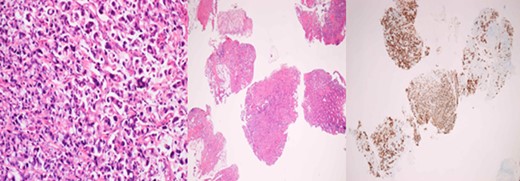 Primary rectal biopsy showing mucinous poorly differentiated adenocarcinoma with signet cells KRAS/BRAS/NRAF negative.