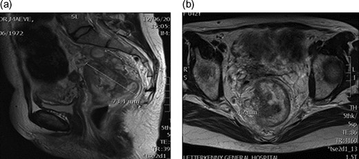 (a) MRI pelvis showing rectal tumour 7.3 cm two lymph nodes. (b) MRI pelvis Mucinous component within 5 mm of the right meso-rectum.