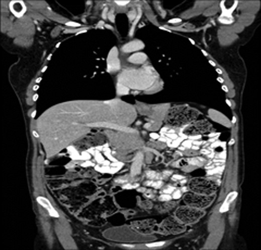 Staging CT TAP showing no distant metastasis.