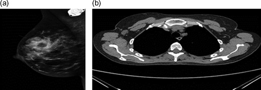 (a) Mammogram post-neoadjuvant chemoradiothreapy showing right breast mass. (b) CT TAP pos-tneoadjuvant chemoradiothreapy showing enlarged right axillary lymph node.