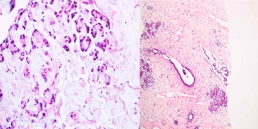 Breast core biopsy showing features similar to the primary rectal cancer.