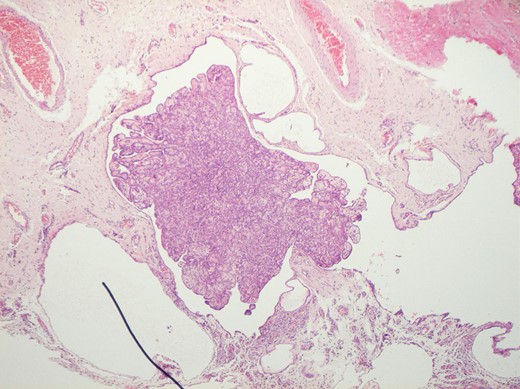 H&E staining of the specimen demonstrating a fibrous cyst wall covered by cuboidal cells with bland nuclei.