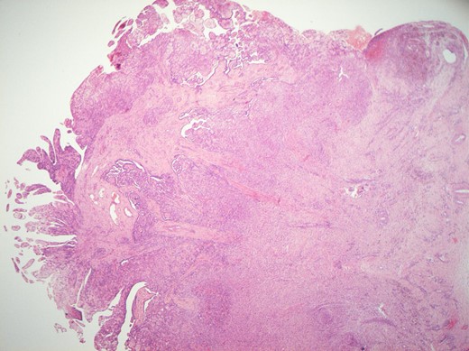 H&E staining of the specimen demonstrating branching, papillary structures with a fibrovascular core lined with a single layer of bland cuboidal cells.