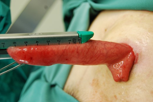 The prolapsed intestine was cut along the axis intersecting perpendicular to the mesentery by GIATM 60.