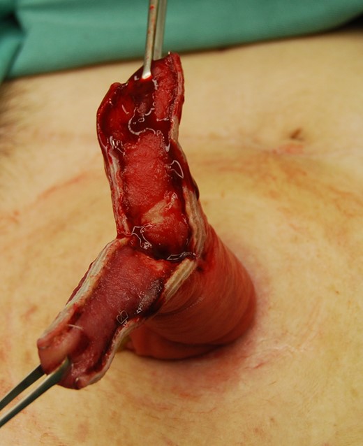 The prolapsed intestine was cut in two places in the major axis direction.