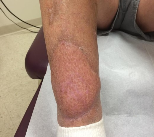 Right lower extremity with fully healed free latissimus dorsi flap coverage of previous radiation wounds.