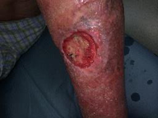 Left lower extremity with persistent non-healing radiation wound after multiple attempts at bilateral lower extremity wound care and hyperbaric treatment. Wound depicted is prior to initiation of UBM therapy.
