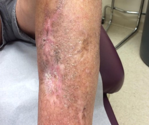 Left lower extremity six months after completion of UBM therapy with healed wound.