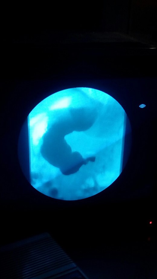 Gastrografin swallow depicting obstruction of the third part of the duodenum with proximal dilation of the stomach and duodenum.