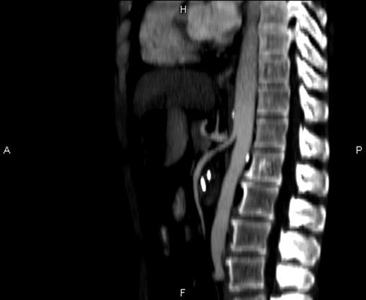 Sagittal CT image and aorta-SMA angle of 15°.