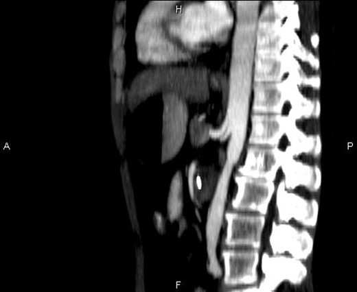 Sagittal CT image showing the entrapment of the duodenum between the aorta and the SMA.