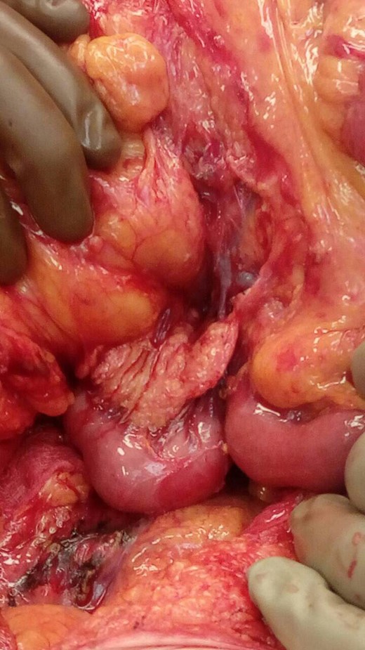 SMA syndrome compression of the third part of the duodenum from SMA.