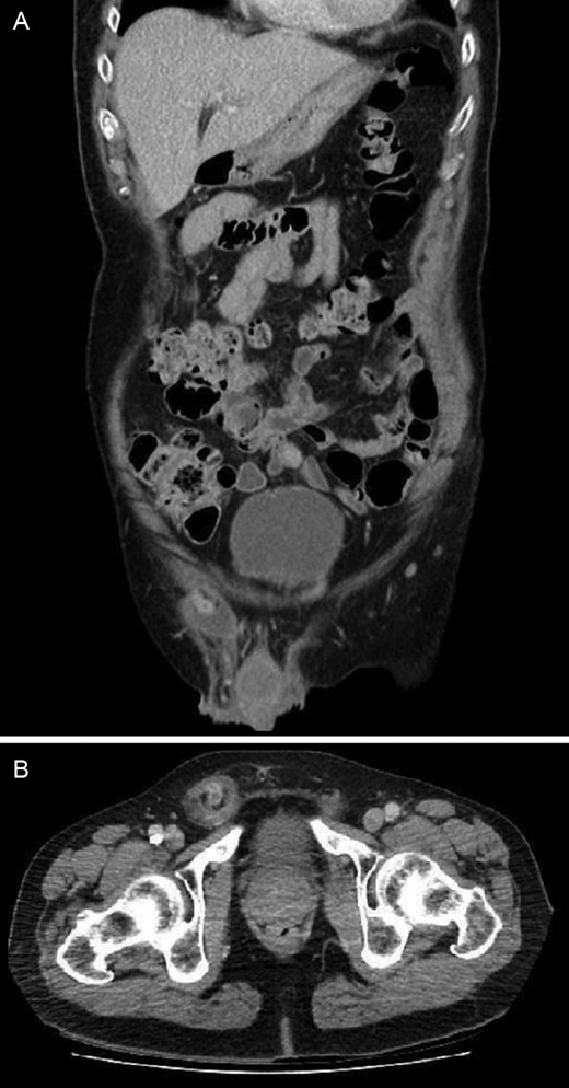 CT showing right inguinal hernia containing contrast filled appendix with dilated lumen, wall enhancement and free fluid within the hernial sac: (A) coronal view and (B) axial view.