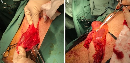 Intraoperative photograph showing acutely inflamed appendix within right inguinal hernial sac (A) and shown after sac opened (B).