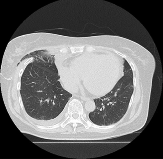 Postoperative CT showing lung herniation.
