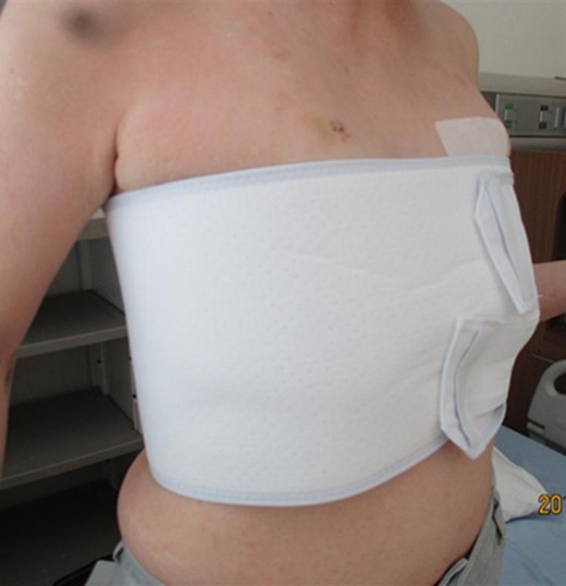 Manual repositioning of the herniated lung by compression bandages.