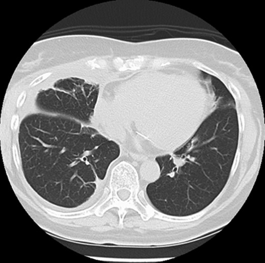Follow-up CT shows that the lung hernia has returned to the thoracic cavity.