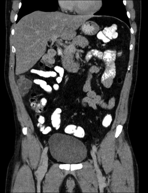 Computed tomography image results: (1) contrast enhanced sagittal reconstruction showing the right flank neoplasm.